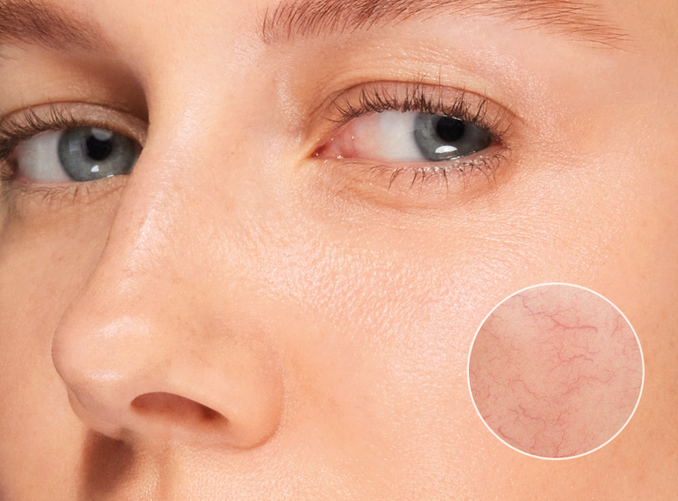 Frau mit Nahaufnahme von Couperose im Gesicht