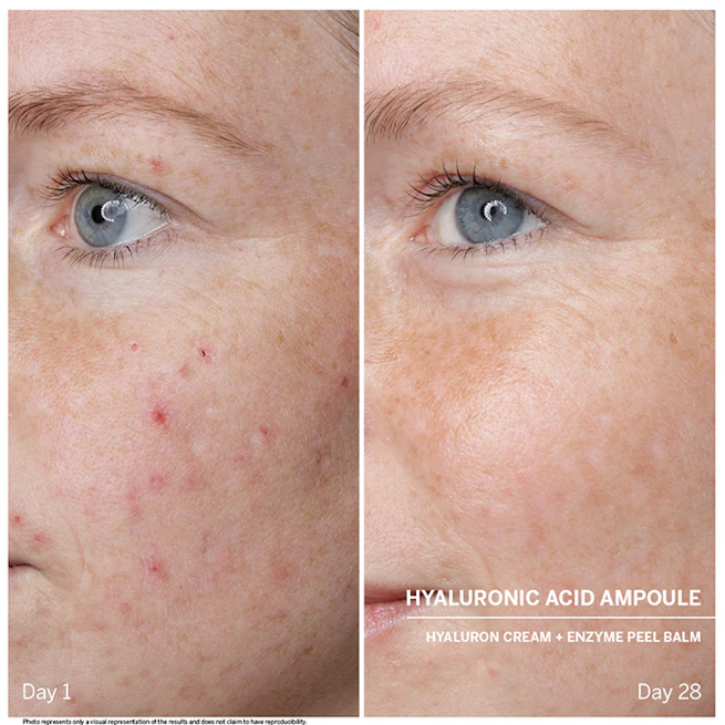 Vorher / Nachher: Gesicht im Vergleich nach 28 Tagen Hyaluron Anwendung