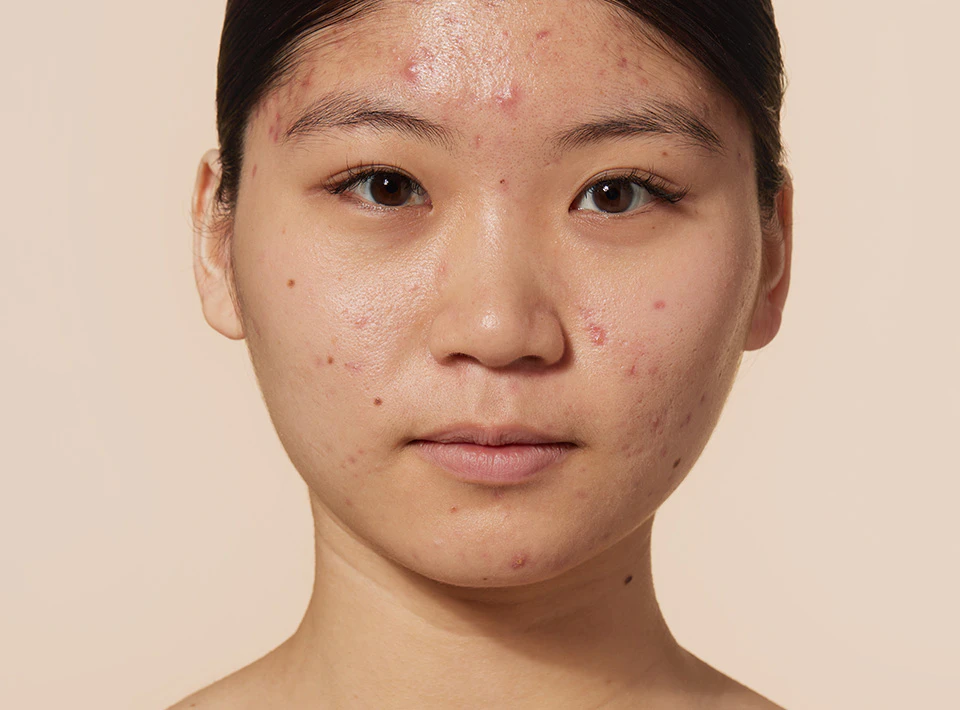 Vrouw met zuivere huid, acne en puistjes
