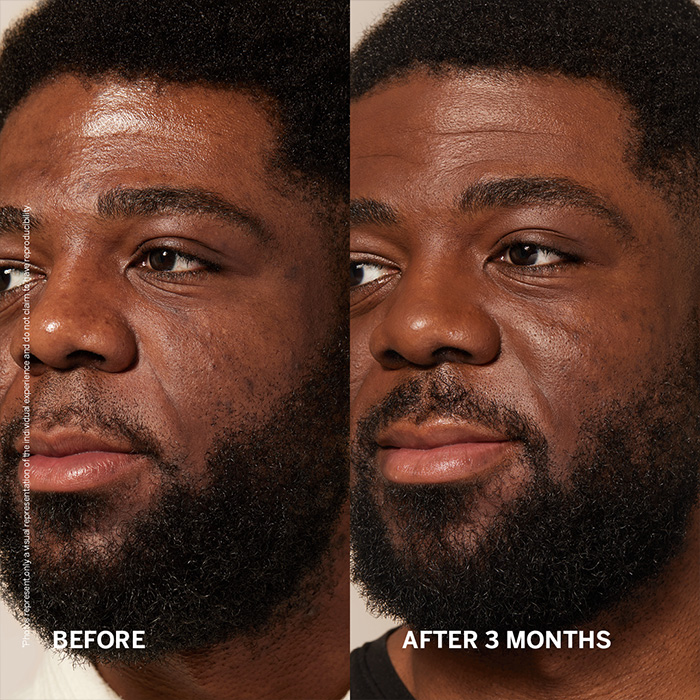 Vorher Nachher Fettige Haut bei einem dunkelhäutigen Mann