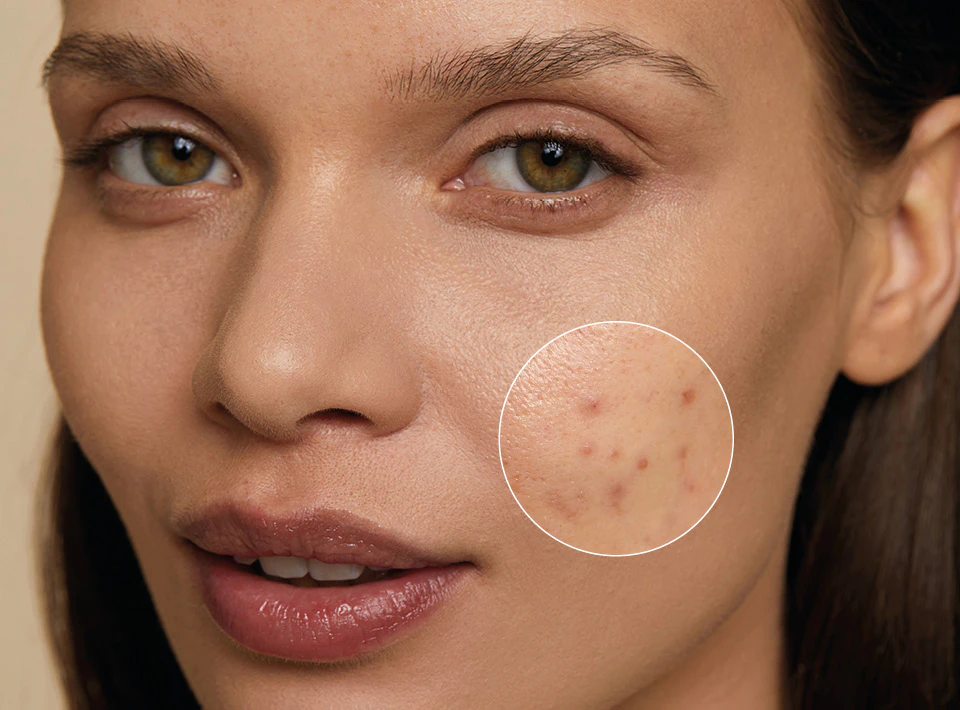 sectie In zoomen verraad Onzuivere huid | Producten & tips tegen puistjes – BABOR BABOR cosmetica en  huidverzorging online kopen.